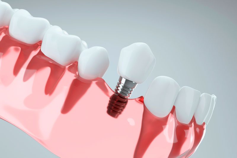 Dental Implants Here